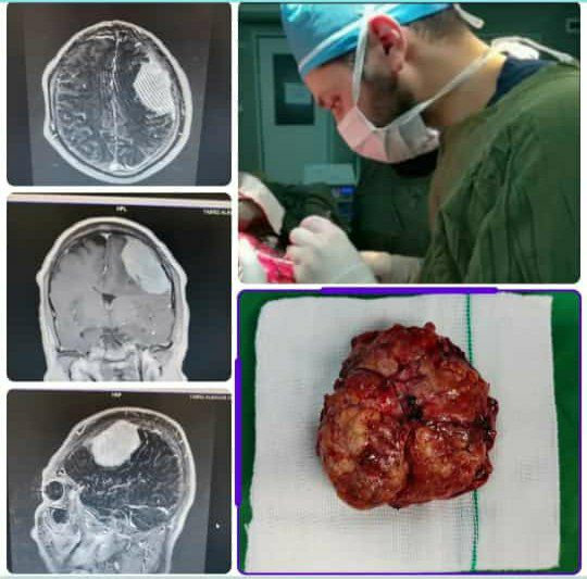 خارج کردن تومور ۲۰۰ گرمی از مغز بیمار در بیمارستان شهدای پارس آبادمغان